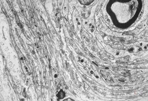 F,12y. | hypertrophic (onion bulb) neuropathy - n.suralis